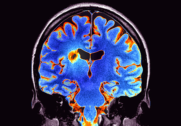 Po treku přestal Matěj cítit nohu. Vyšetření odhalilo roztroušenou sklerózu