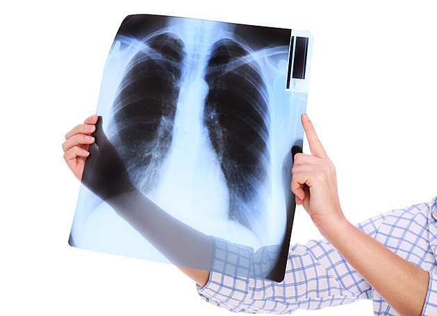 Cítil se zdravý, ale v plicích mu rostl nádor. Zachránila ho prevence